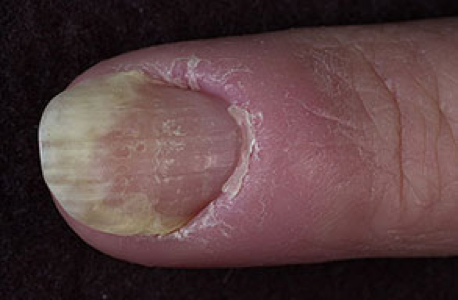 Loslatende nagel door Chemotherapie